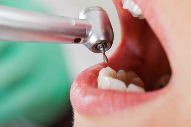 Best Lost Filling or Crown Replacement in Shanor Northvue, PA